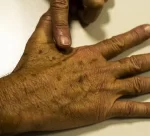 cancer_de_pele_melanoma20220520_0621